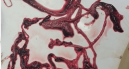 ASSUSTADOR: Embalsamadores encontram veias e artérias cheias de coágulos “nunca antes vistos”, SEMELHANTES A VERMES