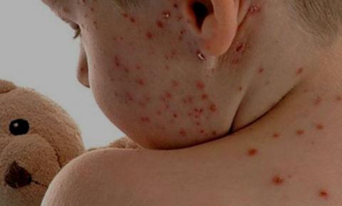 Pesquisa do governo confirma que surtos de sarampo são transmitidos pelos vacinados